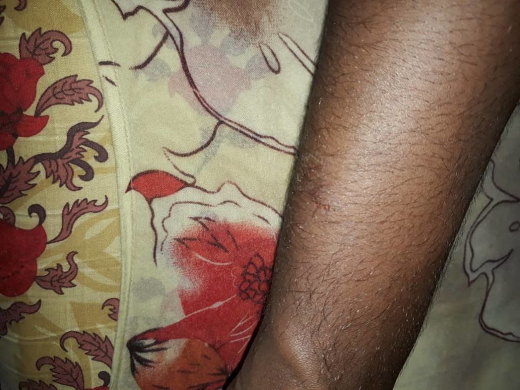 Journalist Abdullahi Hussein Anshur of Radio Kulmiye shows his hand injury after police officer beat him and his cameraman in Mogadishu today Wednesday 22 May, 2019.